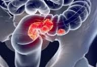 NCCN Adds 2 Tests to CRC Screening Guidelines
