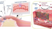 Newly developed injectable, adhesive surgical gel to prevent scar tissue