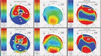 Pinhole pupilloplasty can play role in post-keratoplasty irregular corneas