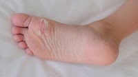 'New Standard of Care' for Capecitabine Hand-Foot Syndrome