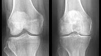 Low Vitamin D Linked to Osteoarthritis in the Knee