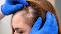 Scientists Found a ‘Magic’ Sugar Gel That Regrows Hair Faster Than Rogaine!