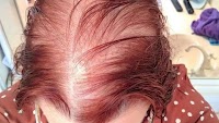 Woman who rubbed onion on scalp to help hair grow now embraces her alopecia after 'years of hiding'