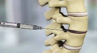 FDA Approves Stem Cell Study for Degenerative Disc Disease