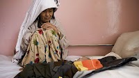 Fact sheets - Malnutrition