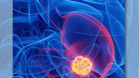 CHMP Recommends Approval of Nivolumab/Ipilimumab in MSI-H/dMMR mCRC