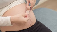 Everything You Should Know About Silicone Scar Tape