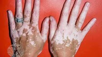VYNE Therapeutics Provides Updates on VYN201 for Nonsegmental Vitiligo and VYN202 for Inflammatory Diseases