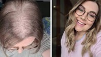 Alopecia sufferer who rubbed onion on scalp in bid for hair growth now embraces condition