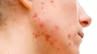 Topical Triple-Agent FDC Gel Found Most Effective and Safe for Moderate-to-Severe Acne in New...