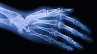 Osteoarthritis treatment in practice falls short of EULAR guidelines
