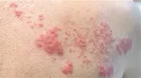 Herpes-Zoster-Impfung wohl auch bei Rheumapatienten effektiv