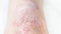 Psoriasis-Patienten vor kardiovaskulären Ereignissen schützen