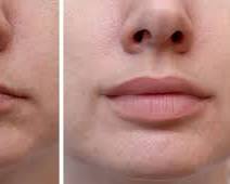 Dermal fillers for lips