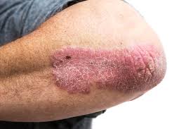 Resultado de imagem para Psoriase