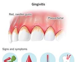 Image of Gingivitis