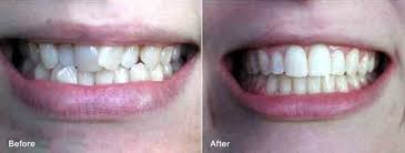 Image result for invisalign images before after