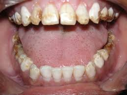 Image result for fluorosis