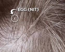 Closeup of head lice eggs (nits) on hairの画像