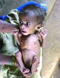 Image result for pictures of malnourished child