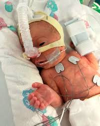 Kobi was born at just 29 weeks, weighing only 3.3lbs. At ...