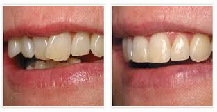 Image result for invisalign images before after