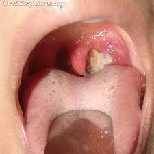 Image result for tonsil stones