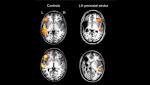  Babies get strokes too. Here's how their brains recover