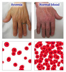 Hasil gambar untuk ANEMIA