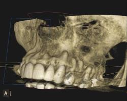 Dental implant removal diagnostic imaging