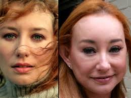 Resultado de imagem para before after surgery