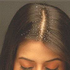 Image result for dandruff