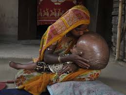 Resultado de imagen para patologias raras del mundo