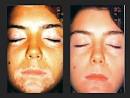 Protopic Scalp Psoriasis Nummular Vitamin Eczema D Artemos