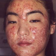 ผลการค้นหารูปภาพสำหรับ สิว
