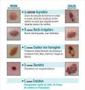 Points cls - Mlanomes de la peau Institut National Du Cancer