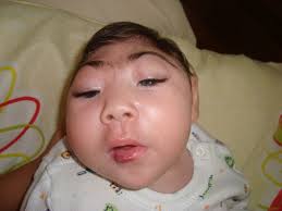 Image result for images of zika babies