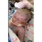  Baby hit by softball treated for fractured skull, brain bleeds