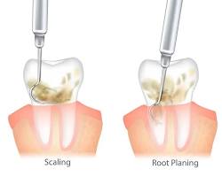 Image of Subgingival Scaling