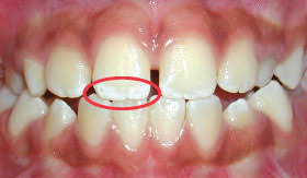 Image result for fluorosis