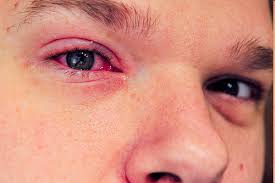 Résultat de recherche d'images pour "eye infection"