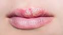 Lippenherpes