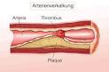 Arteriosklerose Wiktionary
