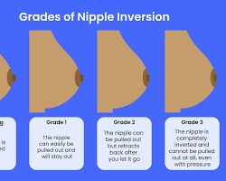 Inverted Nipple