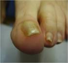 Micosi Unghie Rimedi Naturali Su Excite IT Salute-benessere