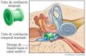 Tubos de ventilacion en ninos