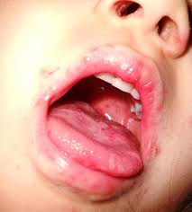 Znalezione obrazy dla zapytania coxsackie wirus