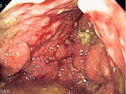 Picture of linitis plastica