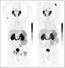 Pre-imaging biopsy Rethinking the Need for Pre-Imaging Biopsy in Prostate Cancer Staging in Elderly Patients