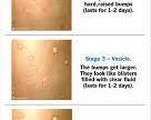 תמונה של monkeypox rash